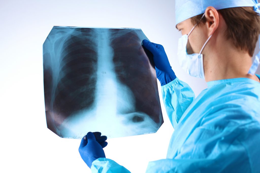 Diagnosing Pulmonary Nodules