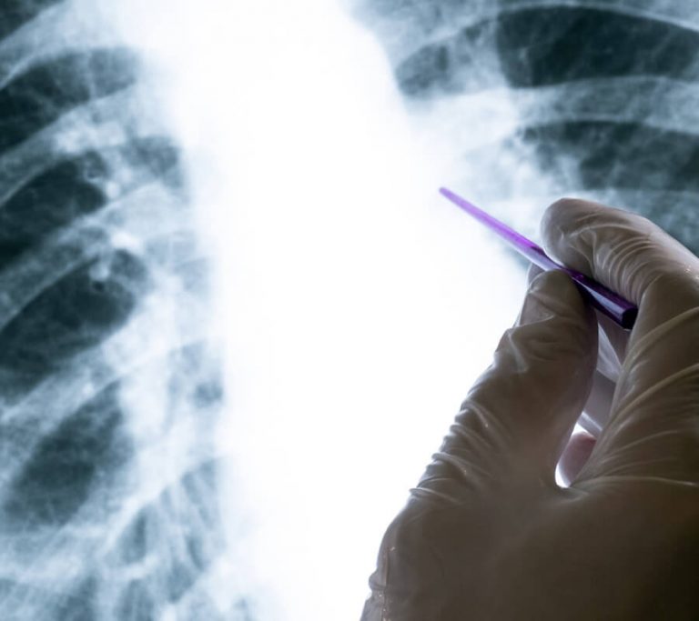 What Causes Tuberculosis
