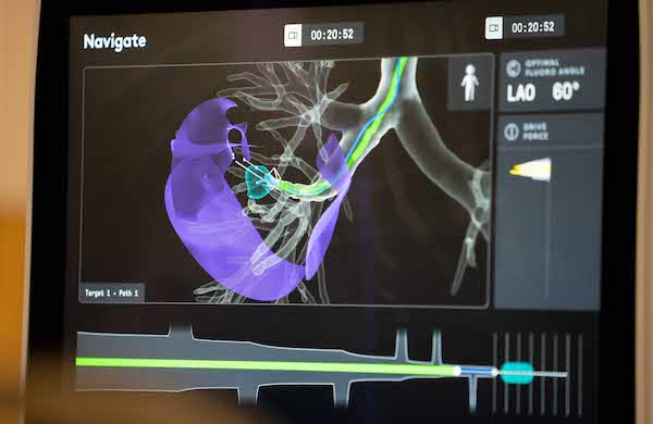 Robotic_Bronchoscopy